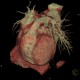 CT angiography of heart: CT - Computed tomography